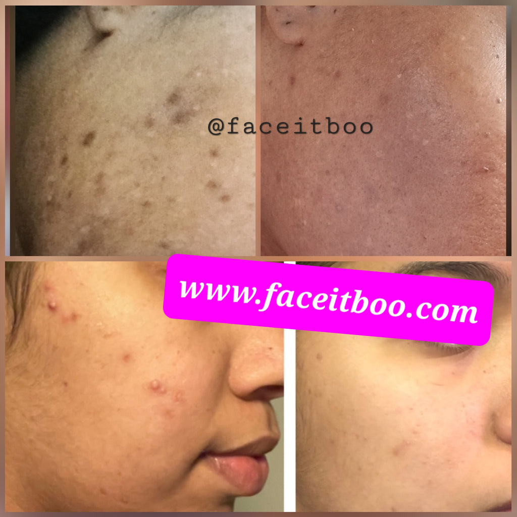 Dark Spot Remover Cream | Dark Spot Cream | Face it, Boo